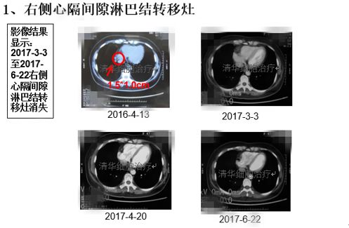 肺鳞癌能用nk细胞疗法吗,肺腺癌nkt治疗成功案例