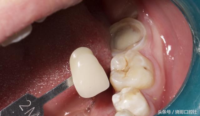 奥齿泰的牙冠是什么材料的,全瓷牙冠哪种材料比较好