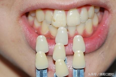奥齿泰的牙冠是什么材料的,全瓷牙冠哪种材料比较好