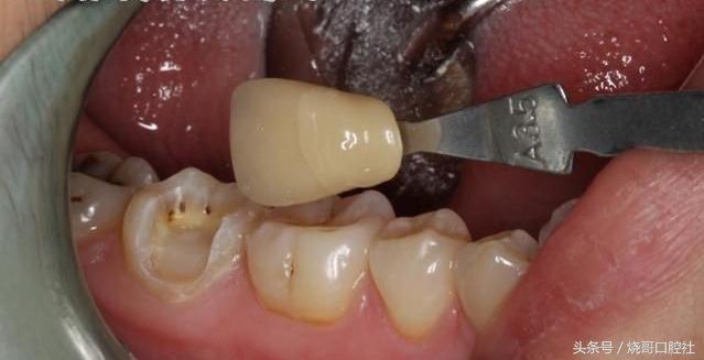 奥齿泰的牙冠是什么材料的,全瓷牙冠哪种材料比较好