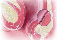 肛窦炎有什么症状和治疗方法,肛窦炎有什么症状和表现