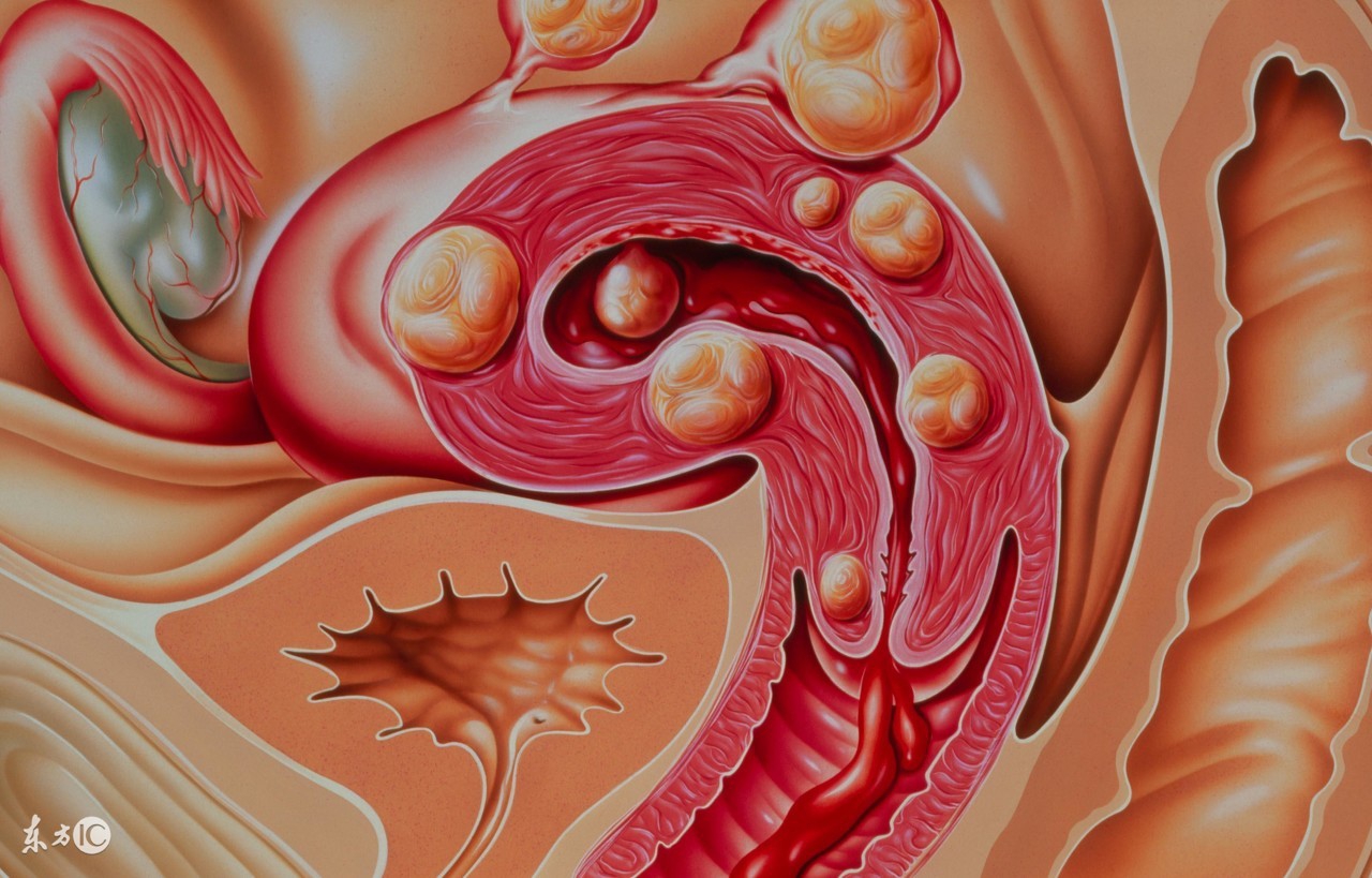 小肚子大是不是子宫肌瘤,子宫肌瘤手术后肚子是硬的吗