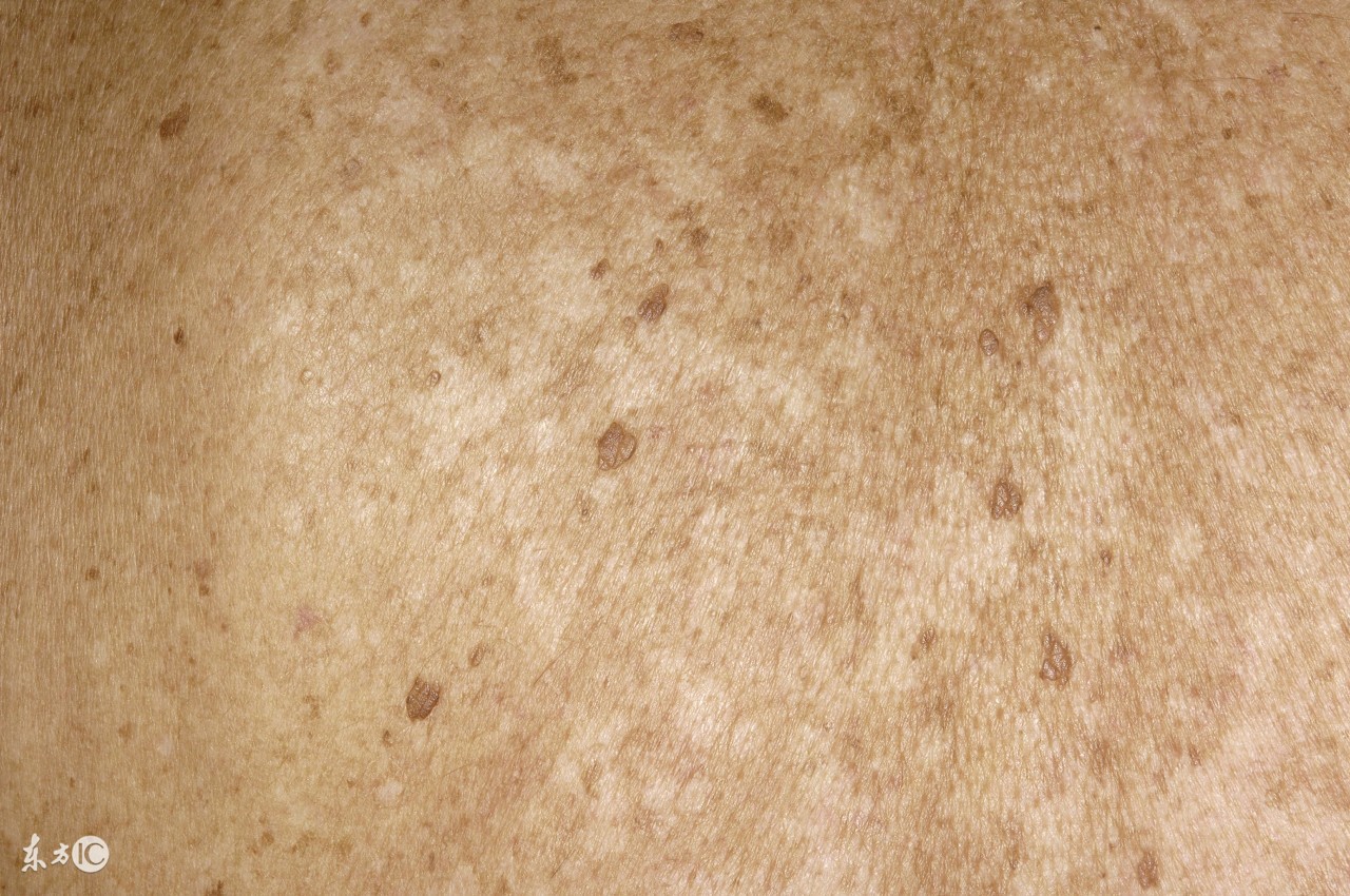 治疗花斑癣的最好方法,治疗花斑癣最快最有效的方法