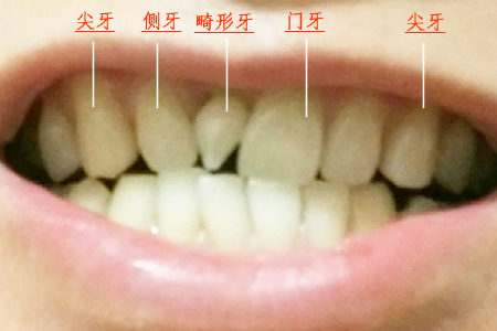 门牙小牙长在旁边怎么办,门牙上方长了一个牙尖如何处理