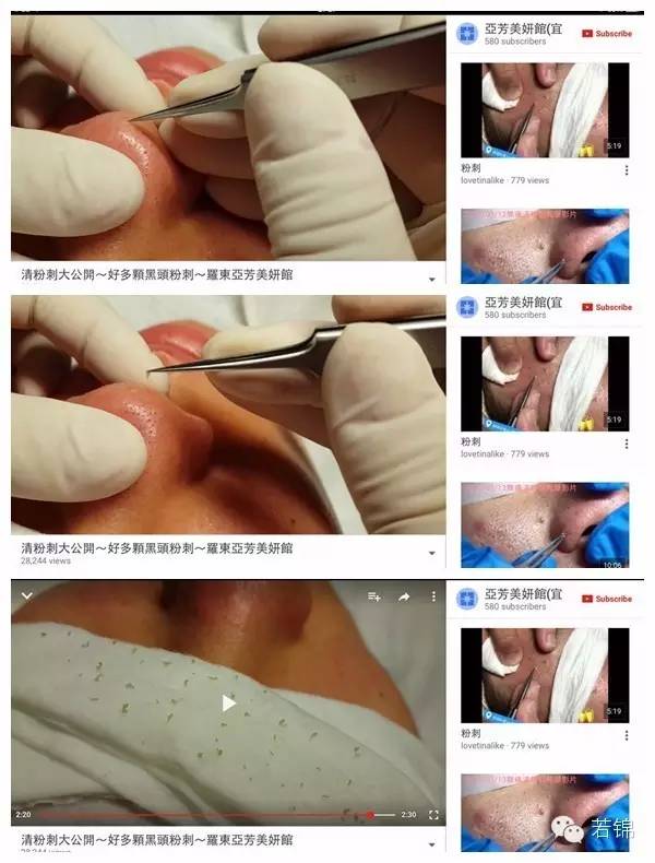 挤黑头过程留一个坑,挤黑头的工具如何使用图解