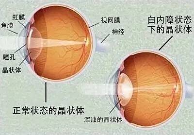 白内障可防可控吗,白内障如何预防和治疗