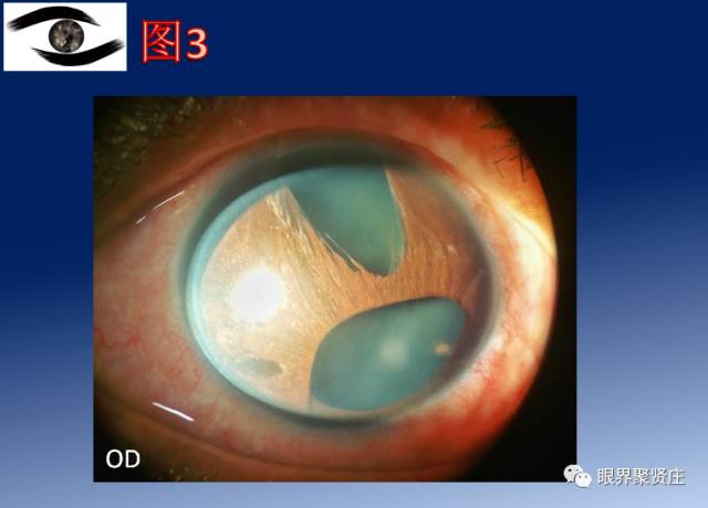 二十种眼型图解阴阳眼,青光眼能做九宫格眼底照相吗
