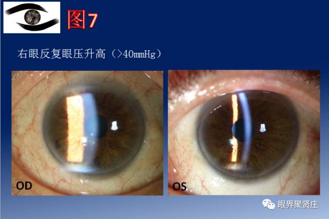 二十种眼型图解阴阳眼,青光眼能做九宫格眼底照相吗