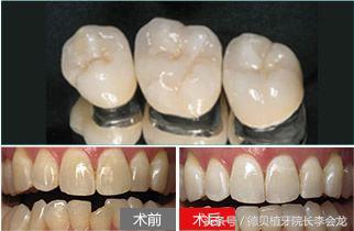 烤瓷牙表面掉瓷了对人身体有害吗,小加工厂做的烤瓷牙对身体有害吗