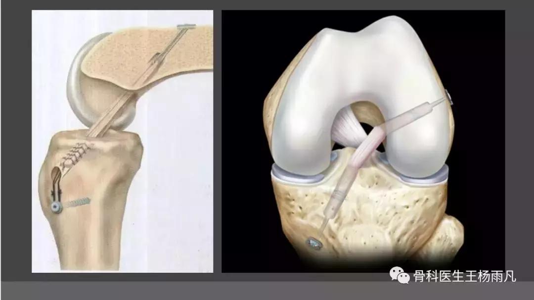 前叉韧带损伤最佳治疗方法,前交叉韧带重建后前叉先松后紧