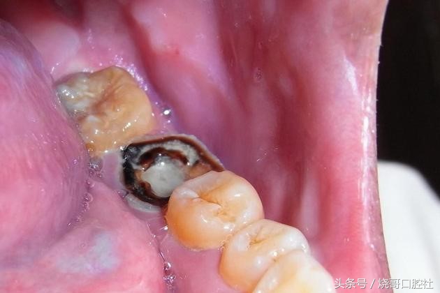 牙神经死掉牙齿发黑,五岁儿童牙神经坏死牙发黑怎么办