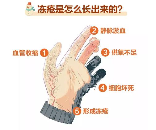 十几度就生冻疮是怎么回事,每次都是10度左右生冻疮