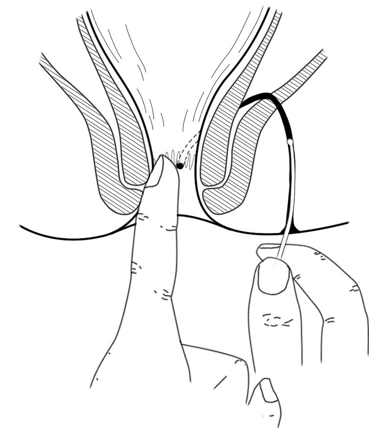 肛肠最新技术,人活一世难免会遇到各种糟心的事