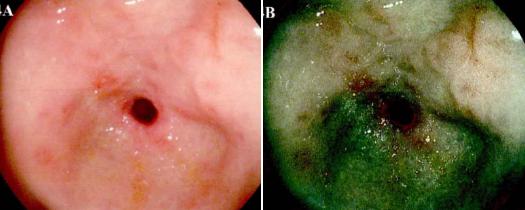 常见的内镜染色方法原理、内镜下表现