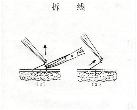 会阴侧切需要拆线吗产妇选择很重要
