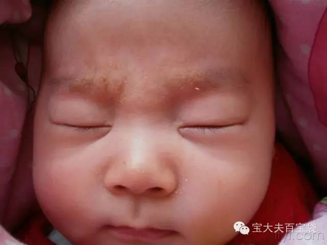 湿疹好了妈妈还需忌口,湿疹来了怎么办