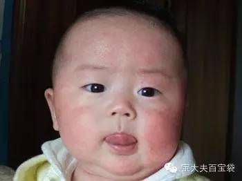 湿疹好了妈妈还需忌口,湿疹来了怎么办