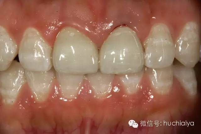金属烤瓷牙不如全瓷牙好看