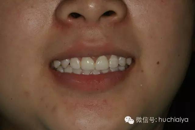 金属烤瓷牙不如全瓷牙好看