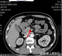 间歇性反酸、腹痛、呕吐咖啡色液体