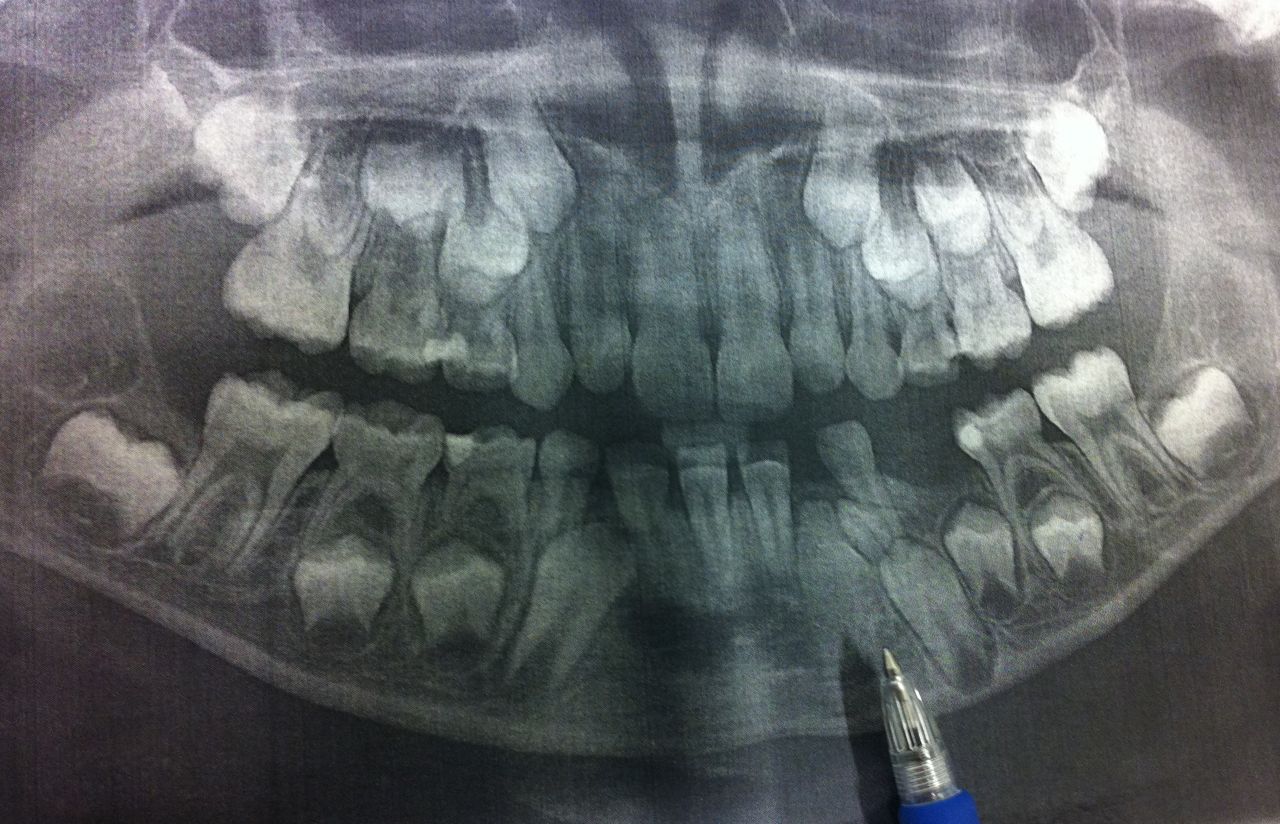 小孩子换牙门牙长出来歪的怎么办,小孩子长门牙中间缝隙大怎么办
