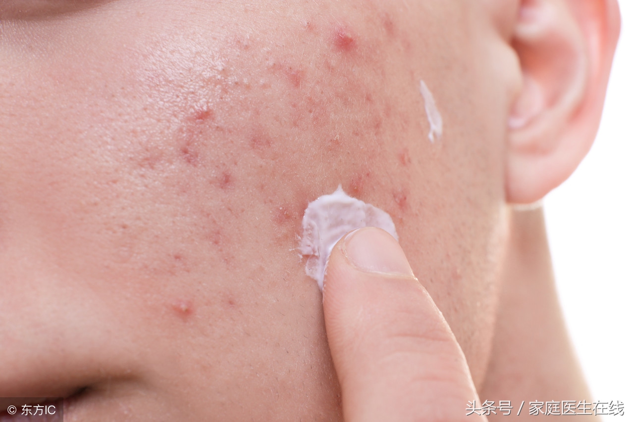 祛斑祛痘自制面膜,祛痘面膜自制