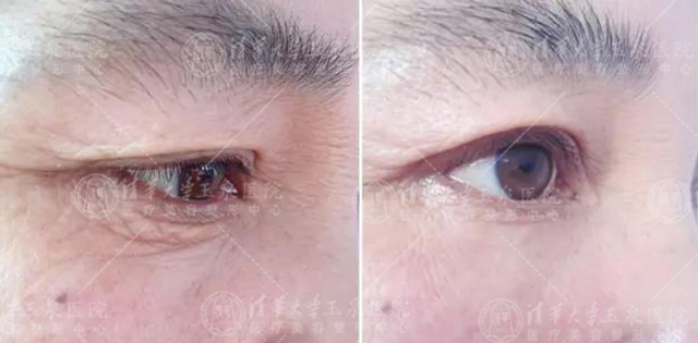 黑眼圈眼纹眼袋是怎么来的,黑眼圈眼袋眼纹问题