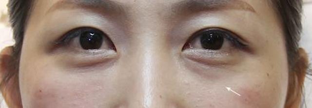 黑眼圈眼纹眼袋是怎么来的,黑眼圈眼袋眼纹问题