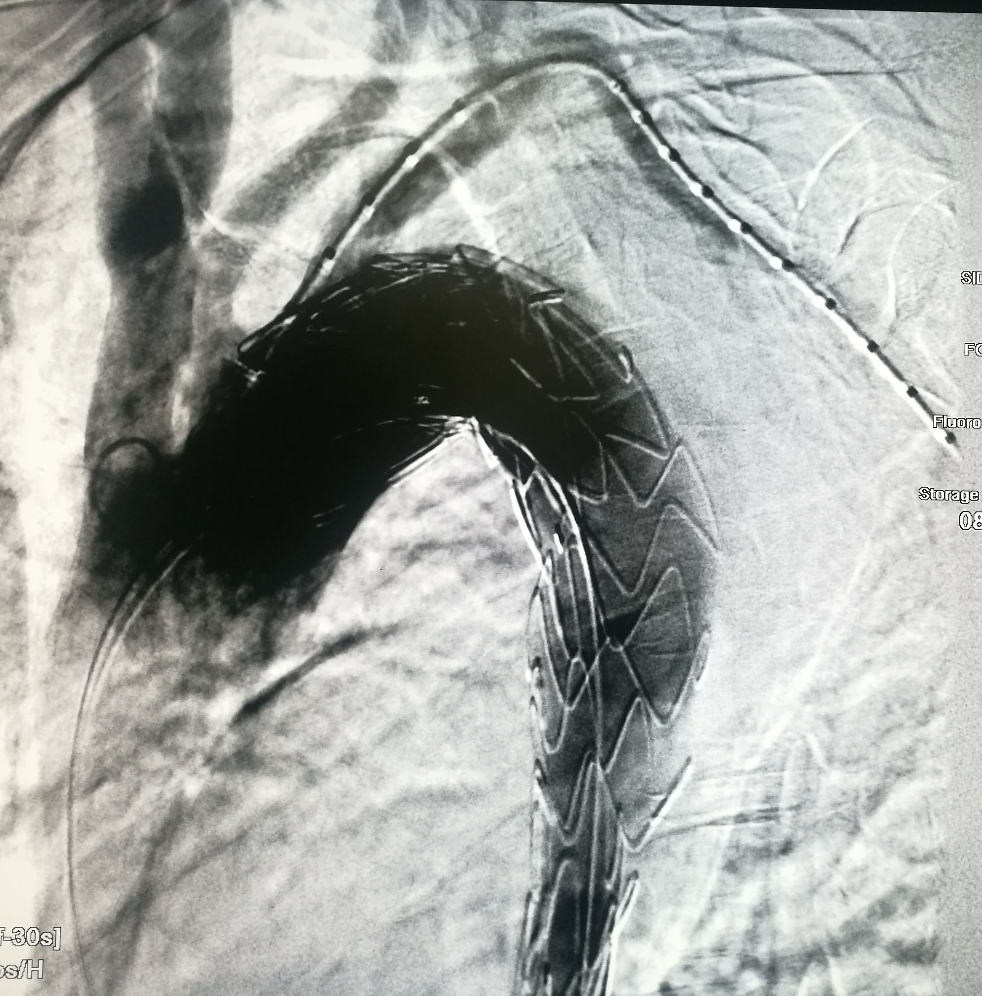 一例凶险主动脉夹层的超声诊断,慢性夹层直径超过5厘米
