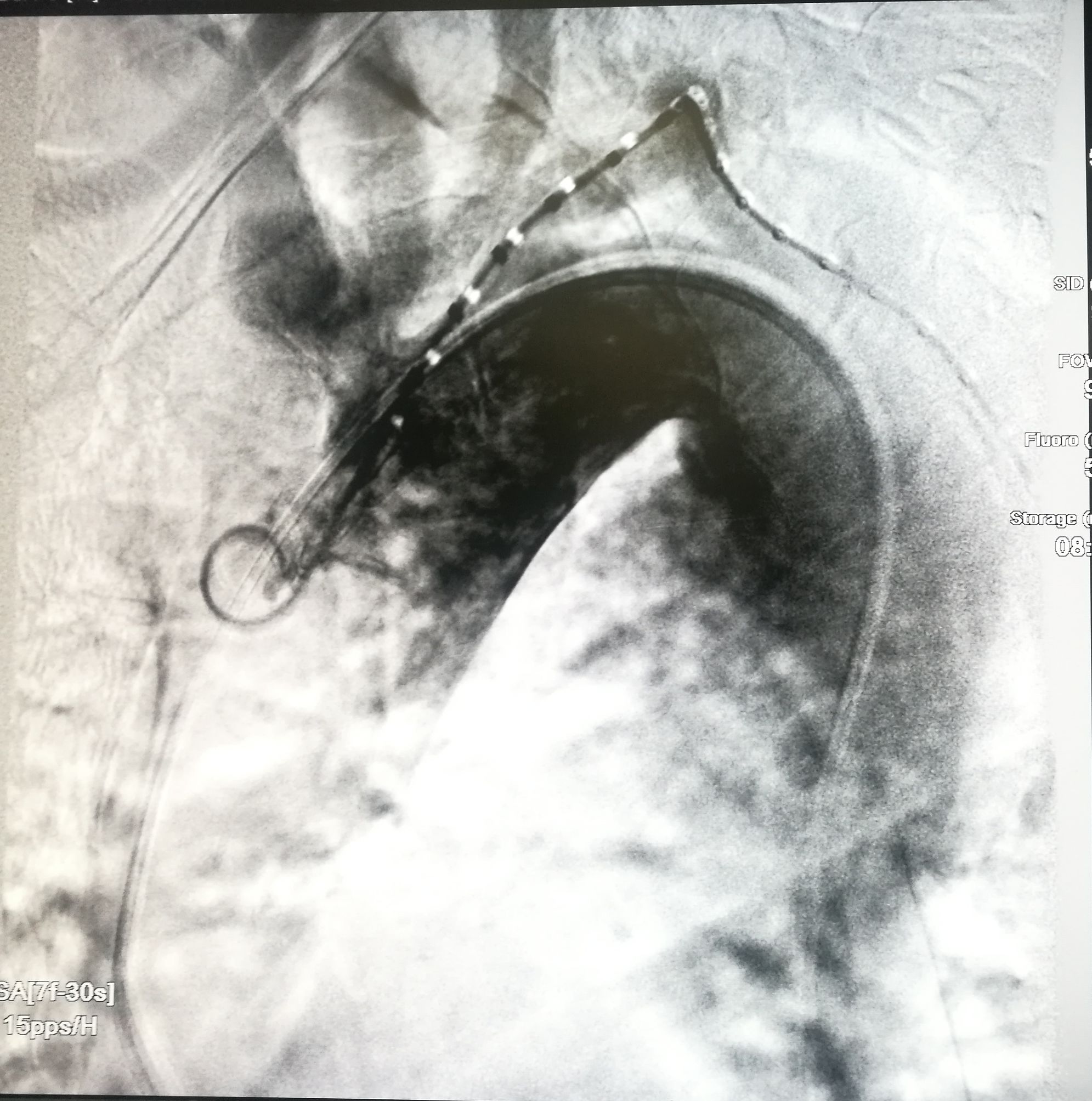 一例凶险主动脉夹层的超声诊断,慢性夹层直径超过5厘米