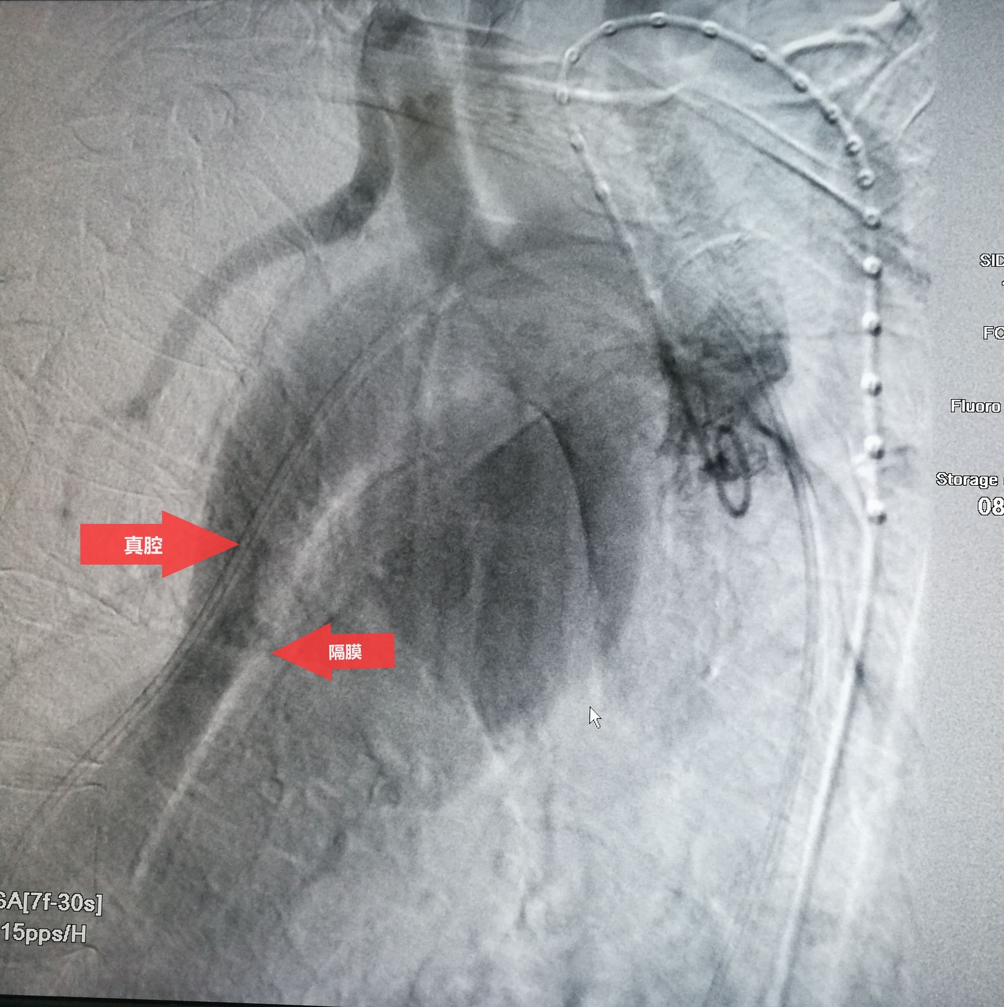 一例凶险主动脉夹层的超声诊断,慢性夹层直径超过5厘米