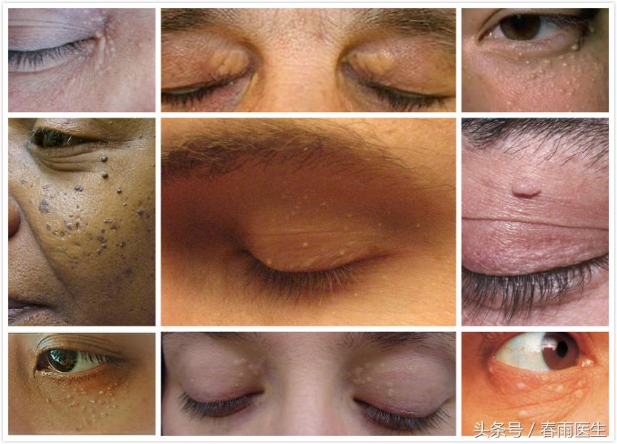眼睛长了脂肪粒什么产品有效,眼周围长脂肪粒和护肤品有关吗