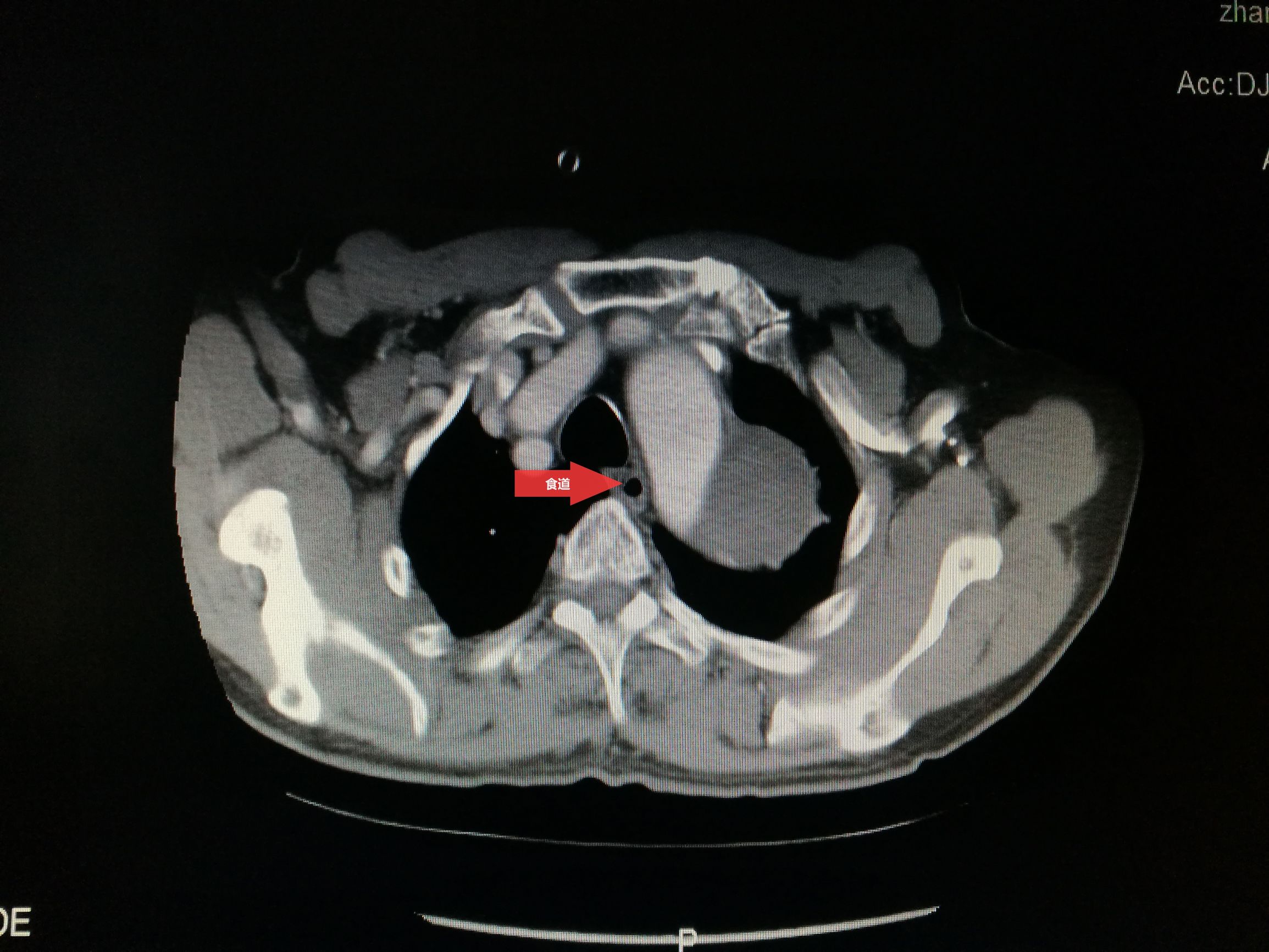 一例凶险主动脉夹层的超声诊断,慢性夹层直径超过5厘米
