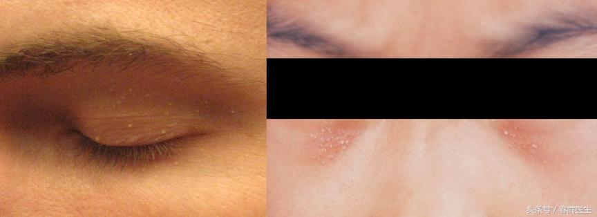 眼睛长了脂肪粒什么产品有效,眼周围长脂肪粒和护肤品有关吗