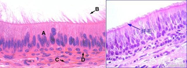 支气管扩张影响寿命吗能治好吗,支气管扩张能治愈吗什么地方能治