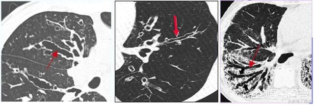 支气管扩张影响寿命吗能治好吗,支气管扩张能治愈吗什么地方能治