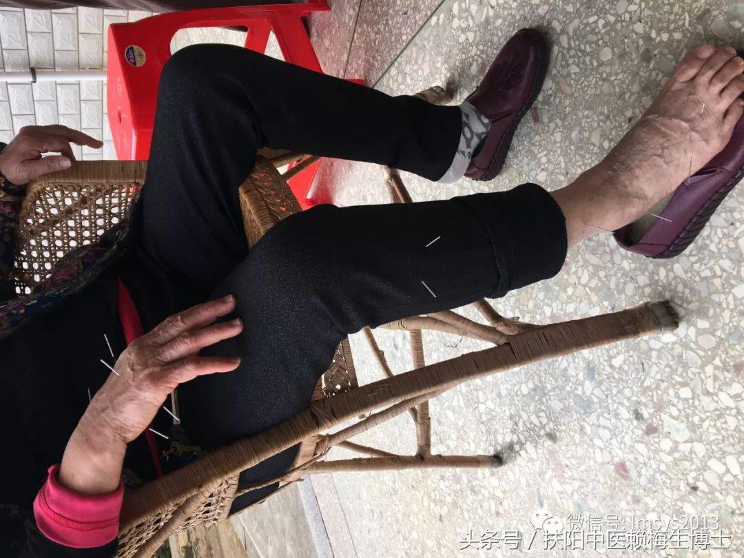 治疗带状疱疹用针灸和放血,带状疱疹内针治疗