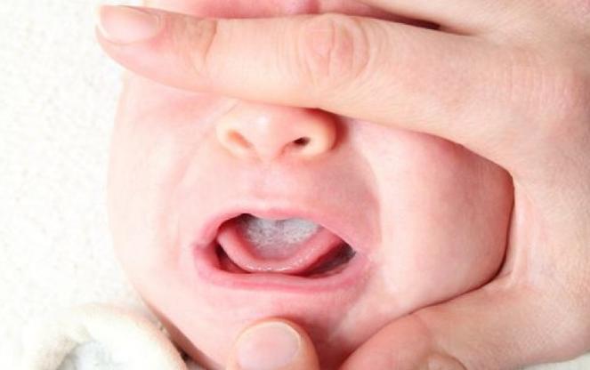 宝宝的鹅口疮怎样才能彻底清除,宝宝鹅口疮最快的方法