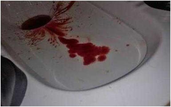 热痔疮和寒痔疮的区别,痔疮息肉和痔疮的区别