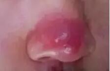 鼻子红红的酒糟鼻怎么护肤,鼻子两侧红血丝是酒渣鼻吗