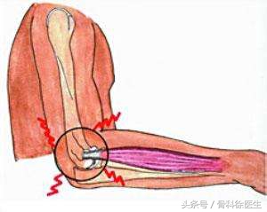 网球肘小臂疼痛难忍,如何缓解网球肘胳膊疼痛