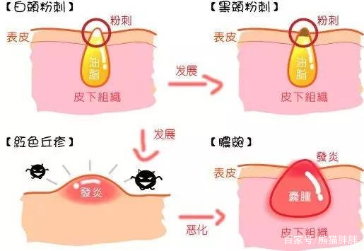 闭口肤质怎么改善,长闭口的正确消除方法