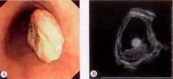 食管癌早期筛查手段,早期食管癌内镜的切除方式有哪些