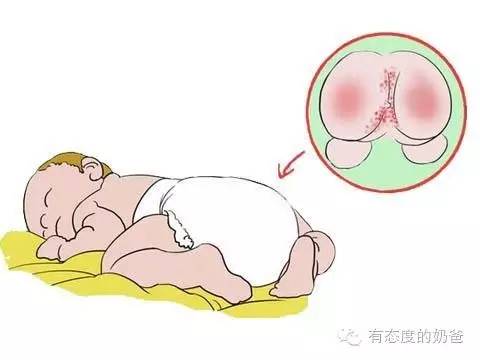 这些错误的护臀处理方法，你千万要记住。