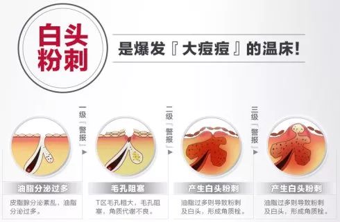 CiCi年希老师：闭口粉刺是什么？那么多人分不清楚它和痘痘的关系