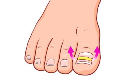 甲沟炎民间偏方用田螺可以吗,嵌甲性甲沟炎有什么偏方吗