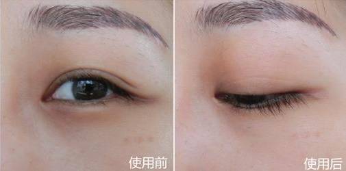 准分子激光美容仪,激光家用美容仪器