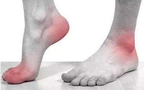 尿酸日常怎么降下来,尿酸降下来了以后该注意些什么