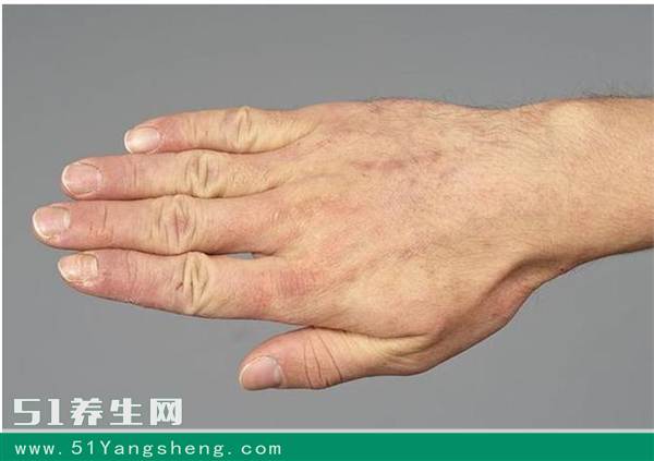 身上手上长红疙瘩很痒是什么原因,潜水后身上起红疙瘩很痒能自愈吗