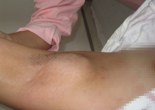 吃完海鲜胳肢窝长出红疙瘩,吃了一顿海鲜